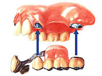 【アタッチメント義歯】